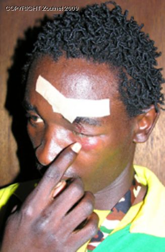Man loses eye in suspected xenophobic attack