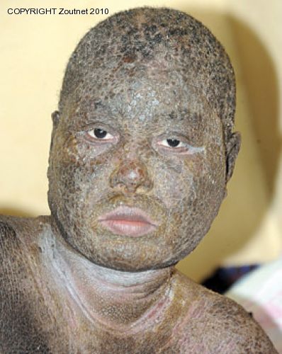 Bedridden pupil spent R47 000 for treatment