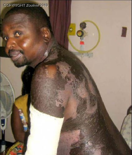 Shock as medicine ´burns´ man´s body
