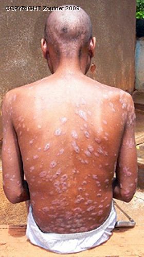 Mysterious skin disease is “eating man alive”