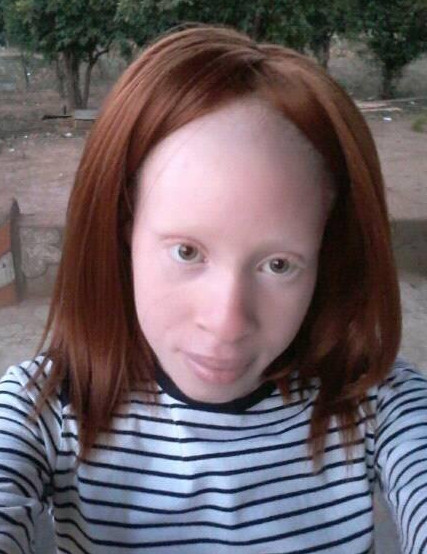 Meet the queen of albinism