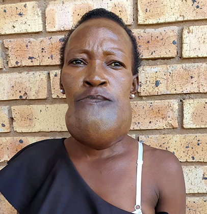 “Tumour on my chin is destroying my life”