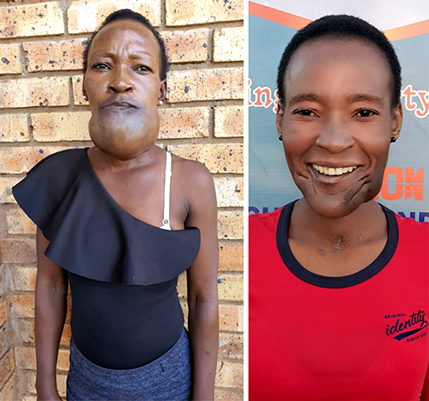 After 20 years of struggling with tumour, Meida can smile again