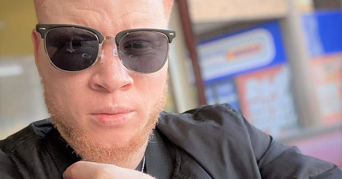 'Do not frown upon people who suffer from albinism'